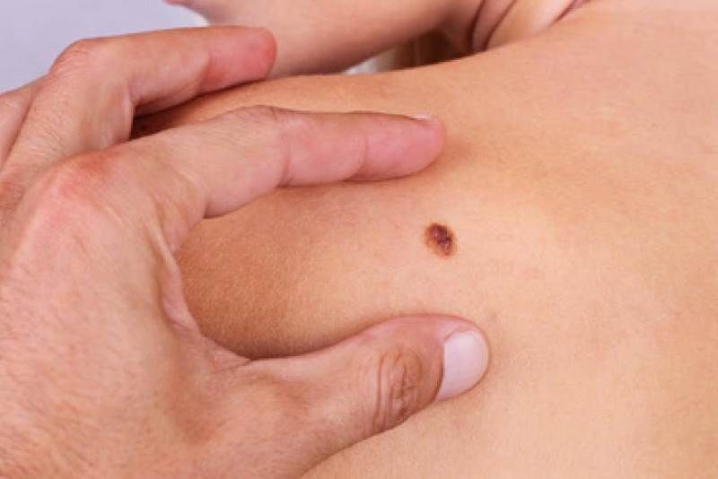 Obolelima od melanoma od iduće godine dostupa savremena terapija